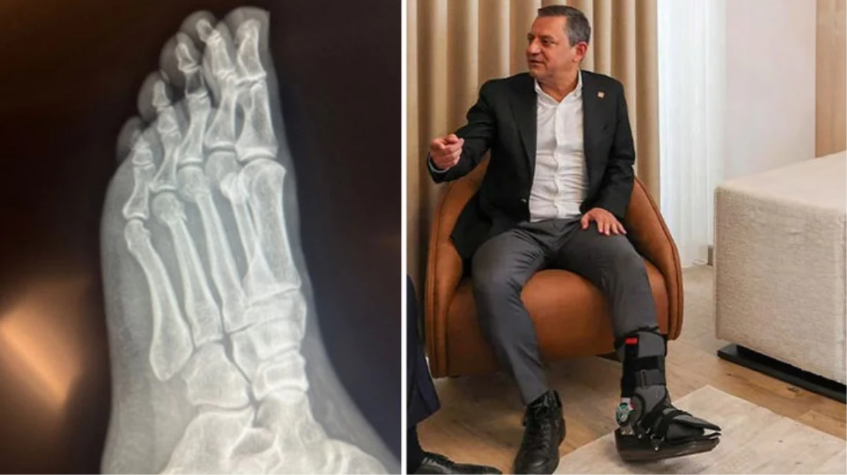 Özgür Özelden Vuruldu iddialarına sert tepki Ayağındaki kırıkların filmleri yayınlandı - Gündem - Dudullu Haber