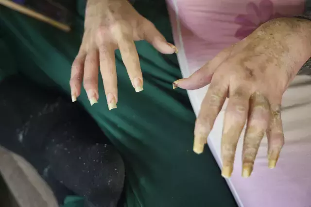 3 yıldır tırnaklarını kesmeyen ve duş almayan gencin eski hali ortaya çıktı